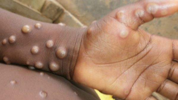 US cases of monkeypox rise to 21: CDC