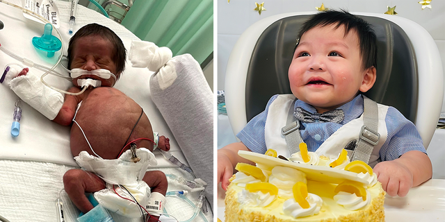Then and now: Newborn Max Do, at left, when he first came into the world — and now, at right, while celebrating his first birthday. 