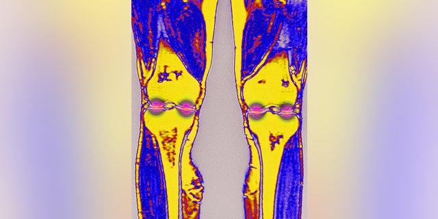 FILE: Osteoarthritis of the knee. Wear then destruction of cartilage in various areas of the knee joint. Frontal MRI scan of the knees.