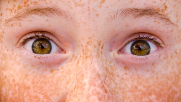 Facts about freckles: Here’s a skin-deep explainer