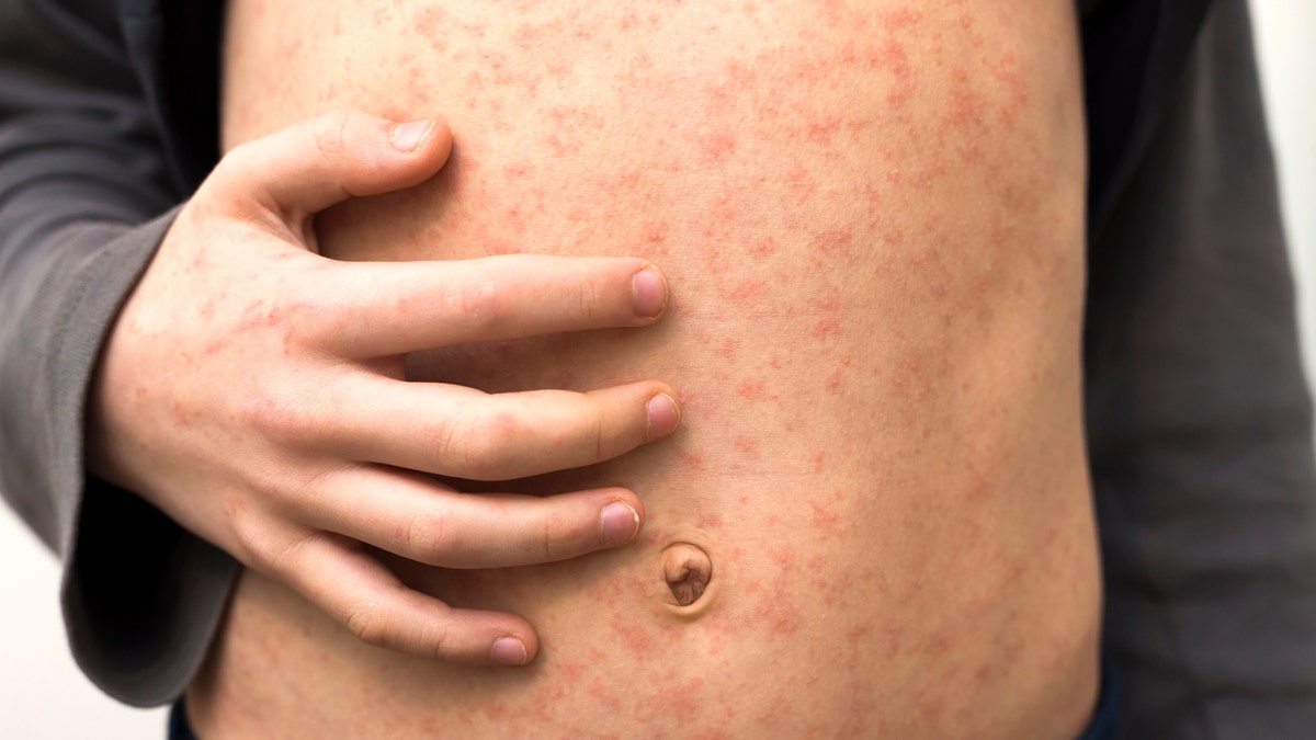 measles on a male torso