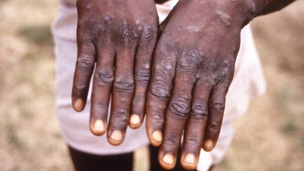 Mpox outbreak in Congo may be a new form of the disease